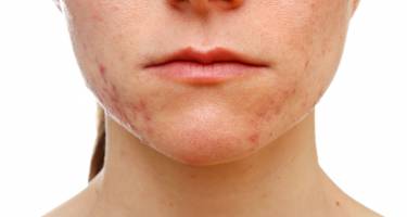 Trądzik różowaty - objawy, przyczyny i leczenie przewlekłego schorzenia skóry