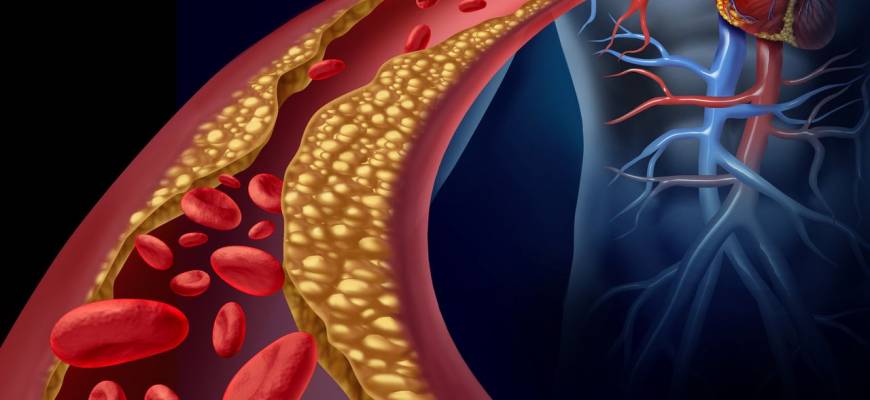 Hiperlipidemia mieszana. Objawy, leczenie i odpowiednia dieta Hiperlipidemia mieszana. Objawy, leczenie i odpowiednia dieta