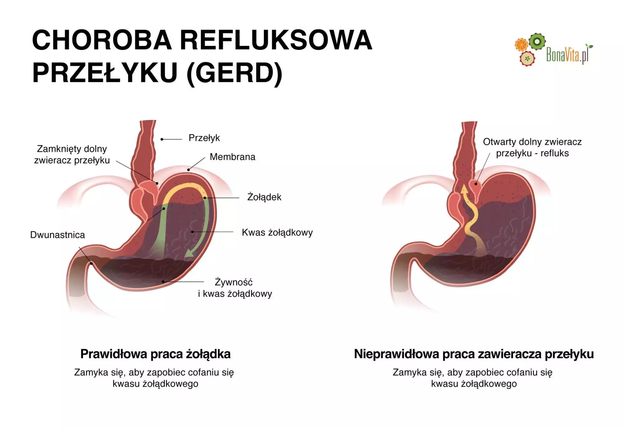Diagram choroby refluksowej i GERD.