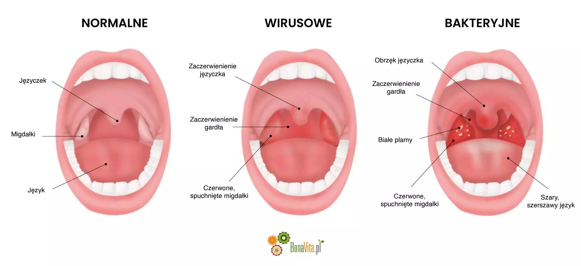 Porównanie anginy bakteryjne a wirusowej