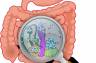 SIBO – zespół rozrostu bakteryjnego jelita cienkiego