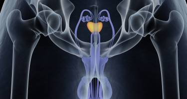 Rak prostaty – objawy, leczenie naturalne. Dieta przy raku prostaty