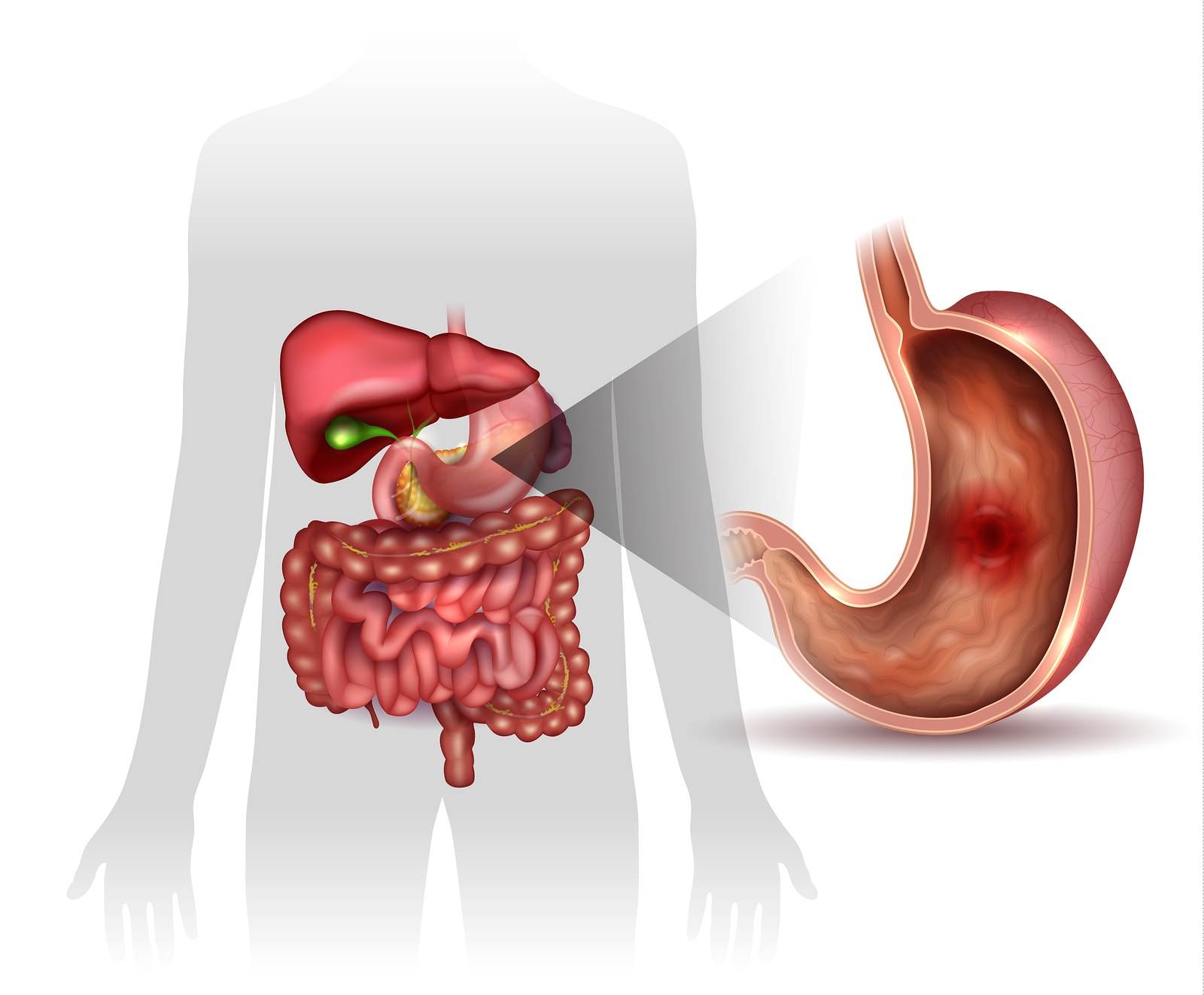 rak żołądka objawy dieta rokowania