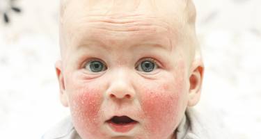 Atopowe zapalenie skóry u dzieci – przyczyny, leczenie naturalne