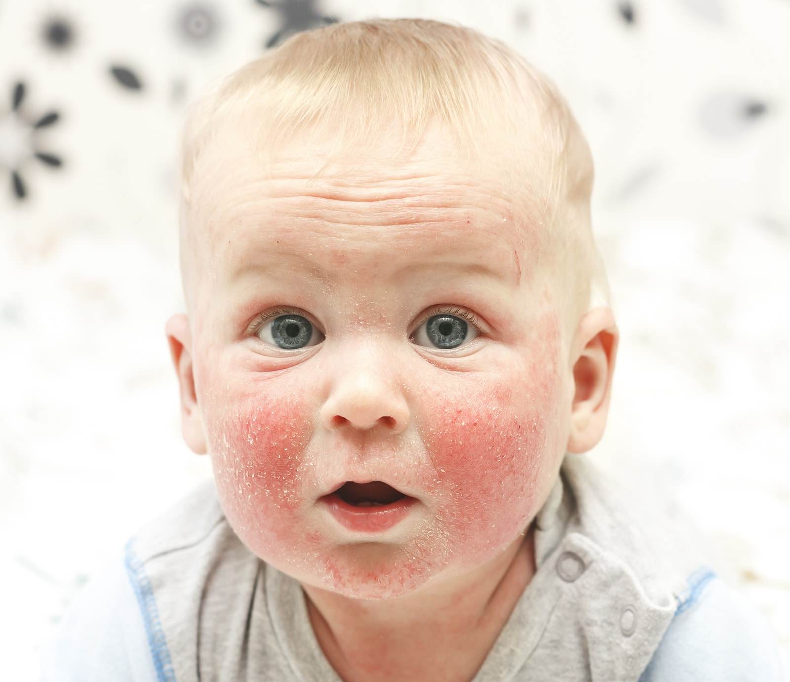 atopowe zapalenie skóry u dzieci leczenie naturalne