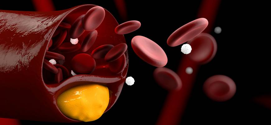 Hipercholesterolemia – przyczyny, objawy, dieta. Hipercholesterolemia u dzieci Hipercholesterolemia – przyczyny, objawy, dieta. Hipercholesterolemia u dzieci